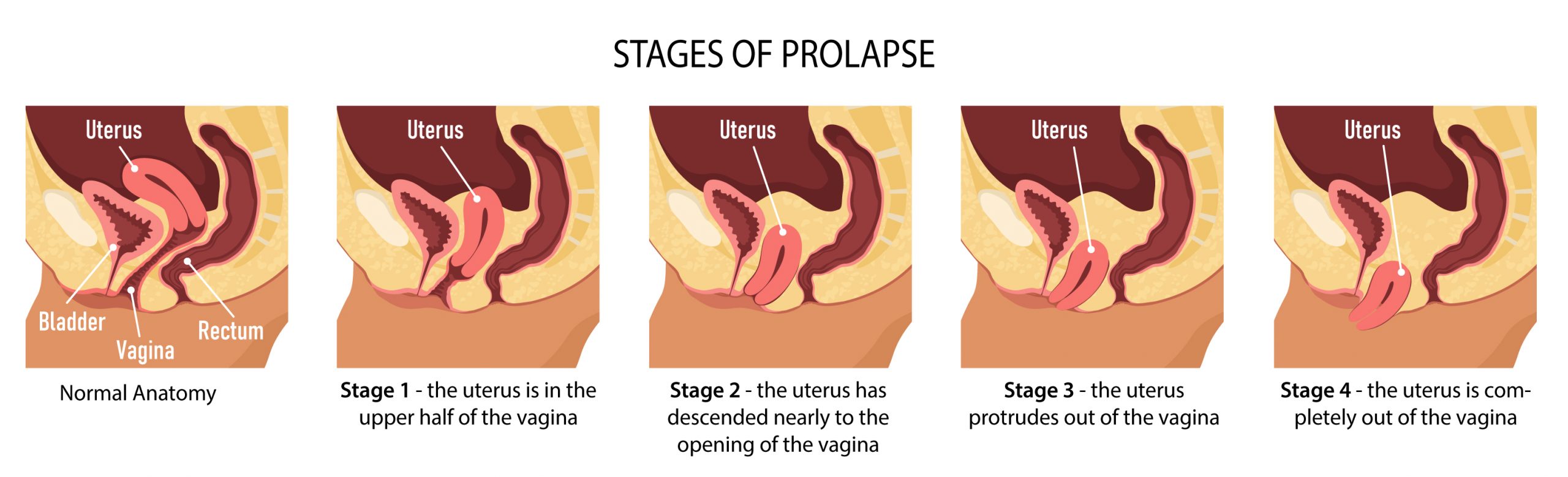 Stages-of-Prolapse-Diagram