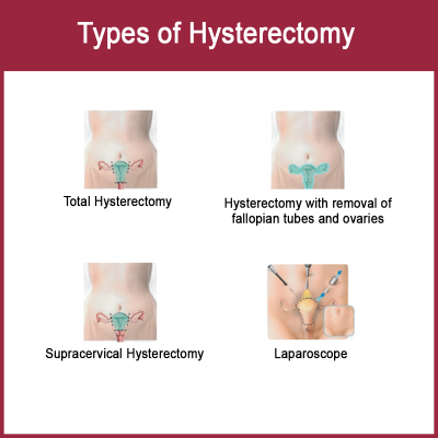 Types of hysterectomy